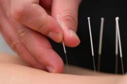 Community acupuncture, acupuncture phoenix